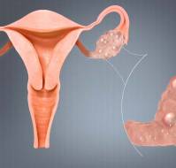 Understanding the Complex Web of Polycystic Ovary Syndrome