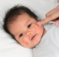 Atopic Dermatitis: An update for parents