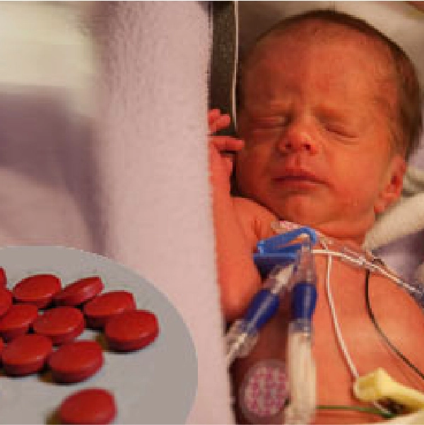 Iron and Neurodevelopment in Preterm Infants