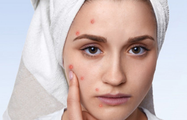Image Know What causes Acne? Symptoms and Treatment 