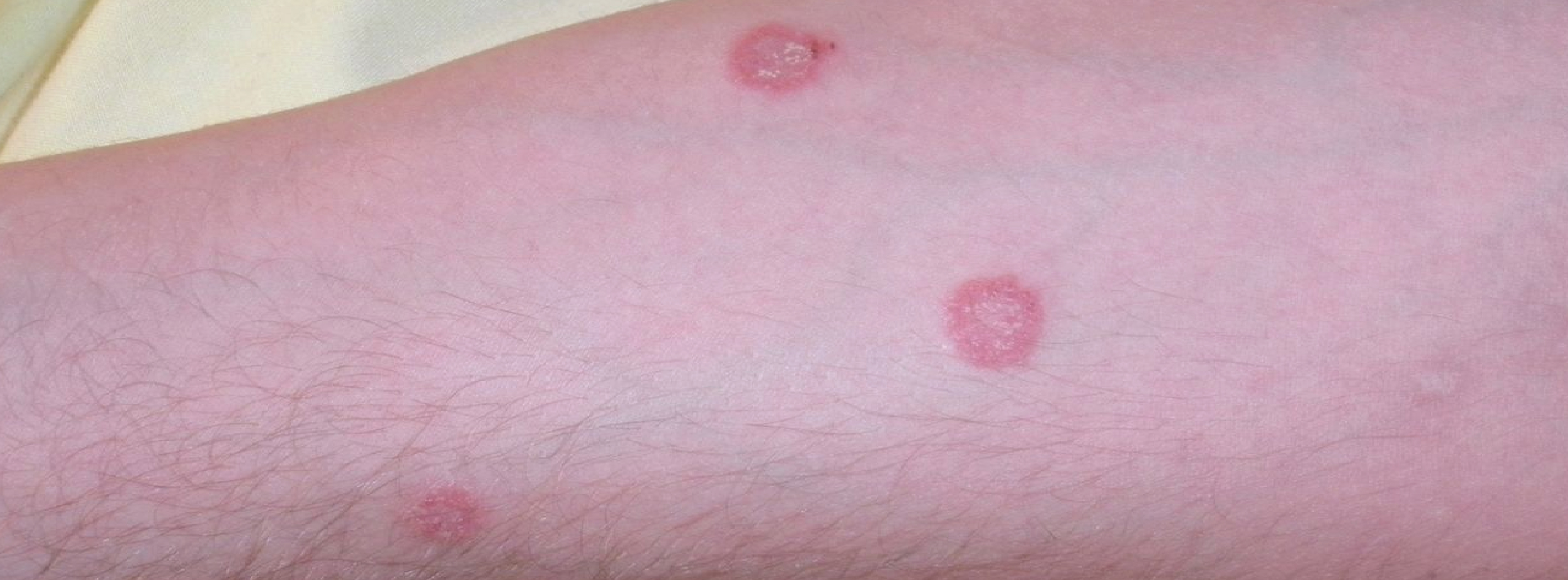 Tinea Corporis Infection a Case-Based Management Approach