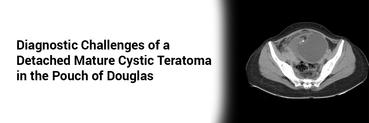 Diagnostic Challenges of a Detached Mature Cystic Teratoma in the Pouch of Douglas