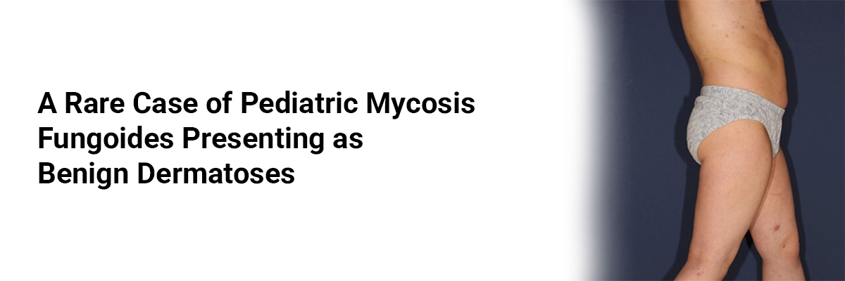 A rare case of Pediatric Mycosis Fungoides presenting as Benign Dermatoses