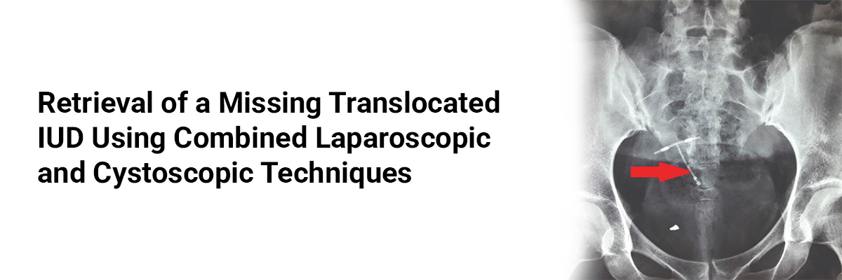 Retrieval of a missing translocated IUD using combined laparoscopic and cystoscopic techniques