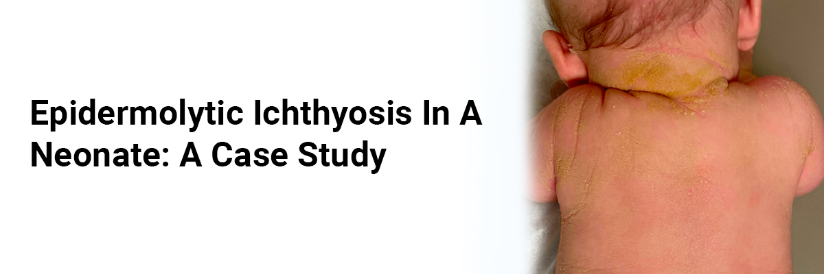 Epidermolytic Ichthyosis in a Neonate: A Case Study