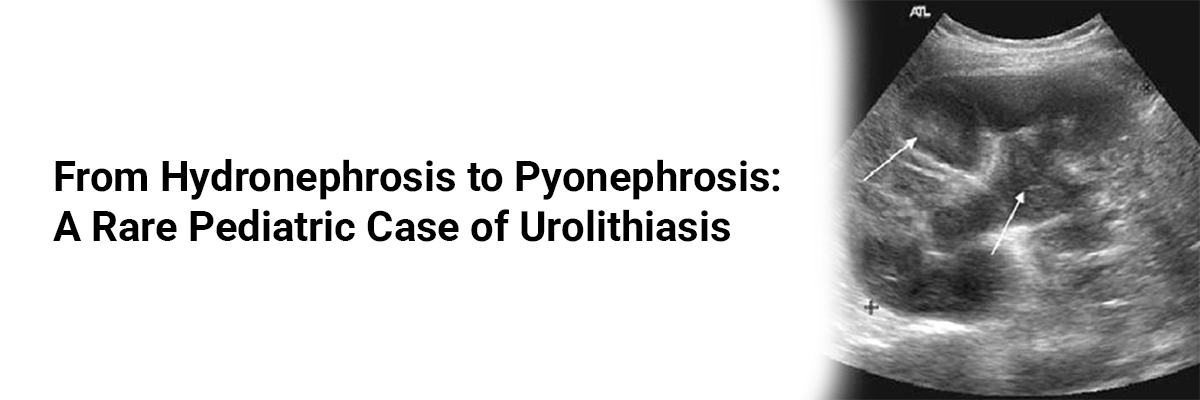 From Hydronephrosis to Pyonephrosis: A Rare Pediatric Case of Urolithiasis