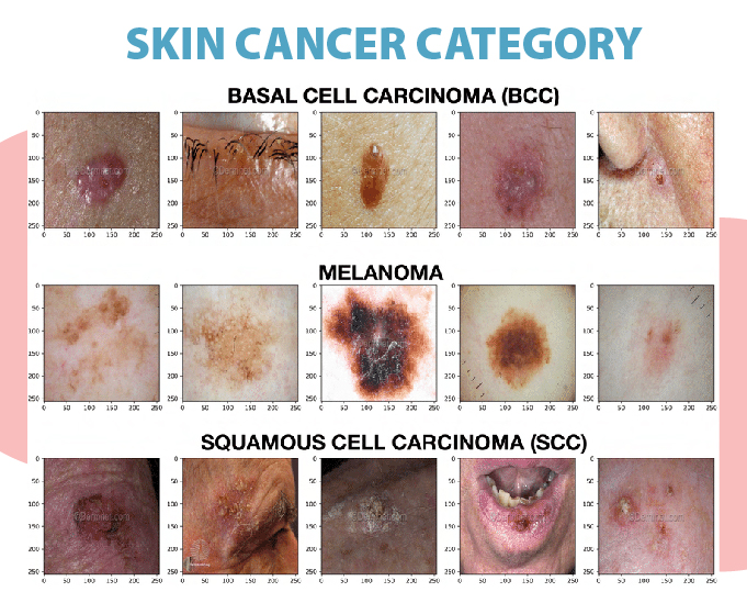 Skin Cancer Symptoms Causes Diagnosis Treatment Medtalks