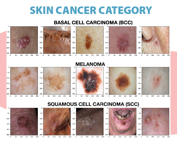 Malignant Skin Lesions